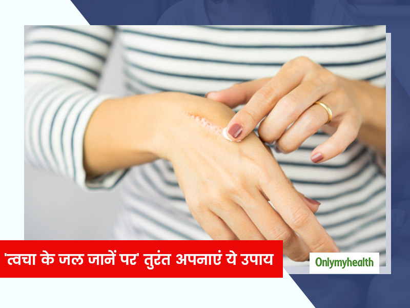 त्वचा के जल जानें पर तुरंत अपनाएं ये 8 तरीके, जानें आयुर्वेदाचार्य से