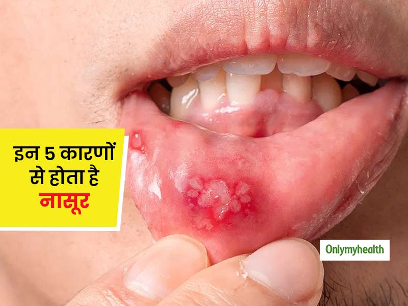 इन 5 कारणों से होता है नासूर, जानिए इसके 10 प्रमुख लक्षण और घरेलू उपचार