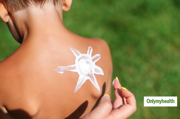 calamine helps in sunburn