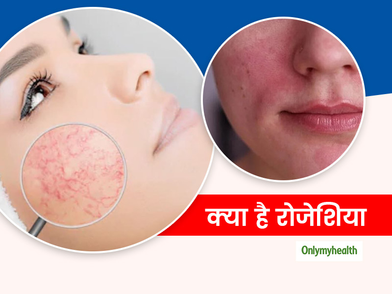 चेहरे का लाल होना हो सकता है रोजेशिया की निशानी, एक्सपर्ट से जानिए कारण और बचाव