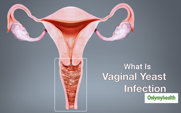 Vaginal Infections And Irritations Hot Sex Picture