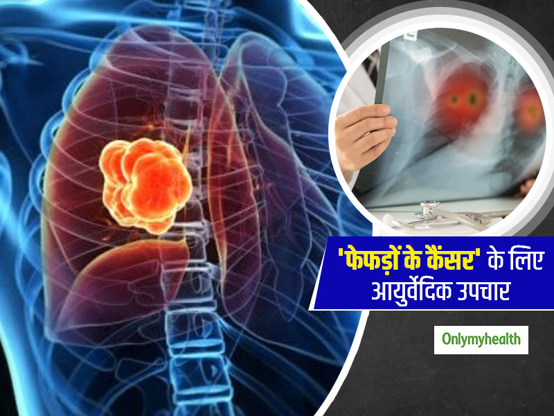 क्या संभव है फेफड़ों के कैंसर का आयुर्वेदिक इलाज? एक्सपर्ट से जानें लंग्स कैंसर में कैसे मददगार है आयुर्वेद