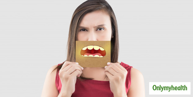 yellowness in teeth is due to fluorosis