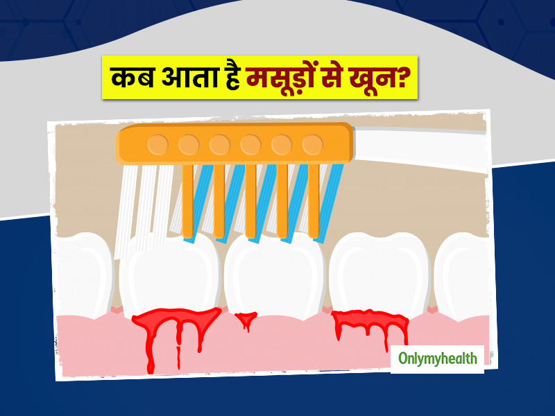 मसूड़ों से खून आने के पीछे छिपे हैं ये 7 कारण? जानें लक्षण और बचाव भी