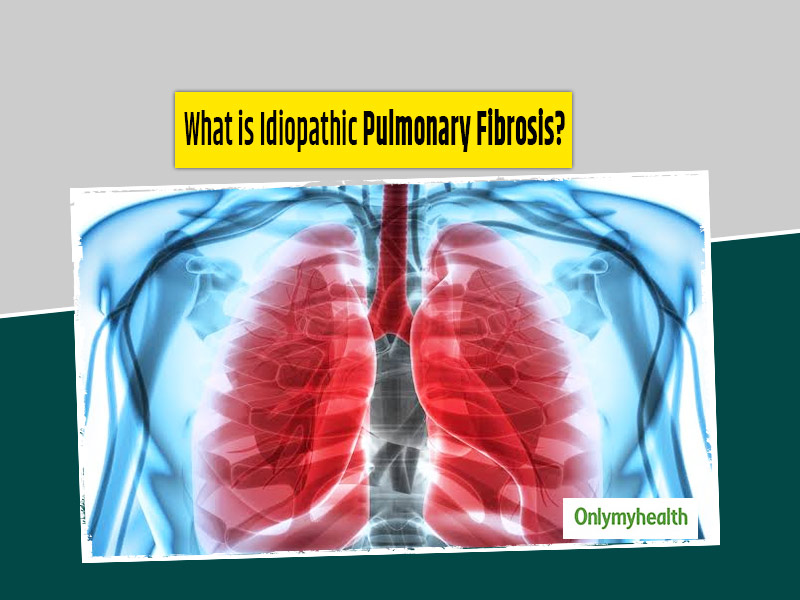 What Is Idiopathic Pulmonary Fibrosis Know Its Causes Symptoms Diagnosis And Treatment