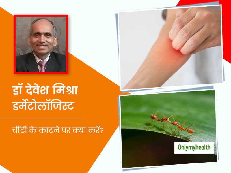 चींटी काटने पर होने वाले जलन और सूजन से पाएं निजात, इस्तेमाल करें ये 9 घरेलू उपाय