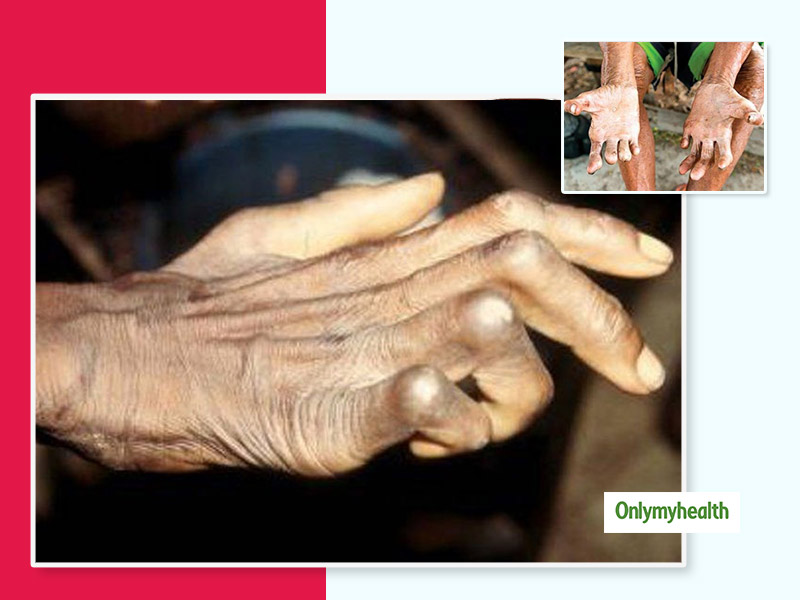 कितना संभव है कुष्ठ रोग (Leprosy) के लिए घेरलू उपाय, जानें क्या है इसका सही इलाज।