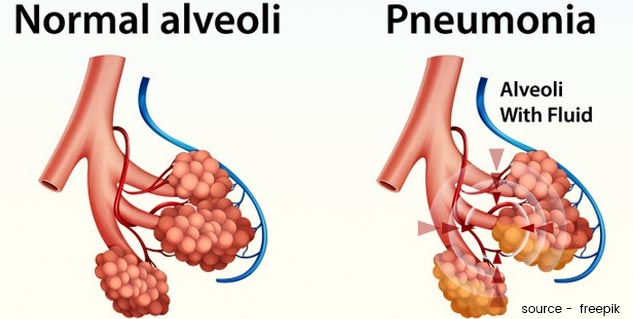 inside24pneumonisymptoms