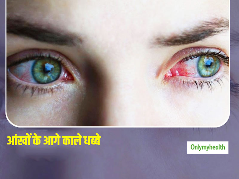Eye Floaters: आंखों में काले धब्बों का होना हो सकता है इस रोग का संकेत, जानें इसका कारण और इलाज