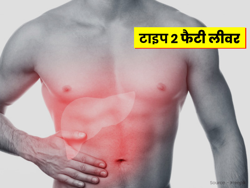 क्या है टाइट 2 फैटी लीवर? जानें इसके कारण, लक्षण और घरेलू उपचार
