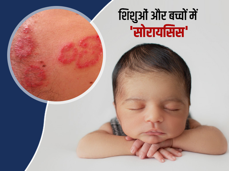 शिशुओं और बच्चों में सोरायसिस के 11 लक्षण, कारण और बचाव के टिप्स