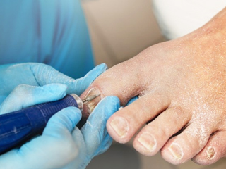 Try These 10 Remedies to Prevent Toenail Infection During Monsoon