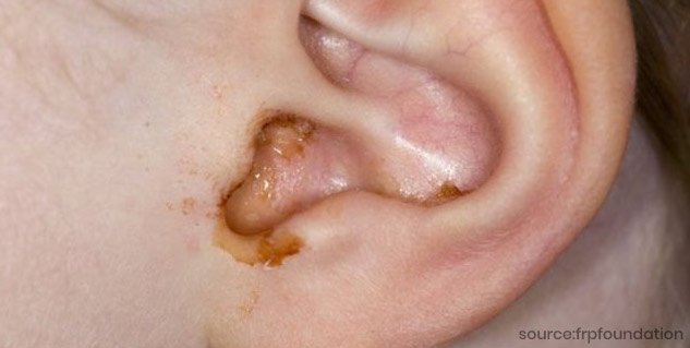 ear infection