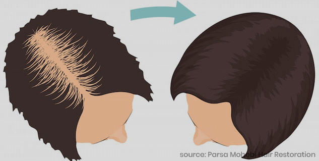 Inside5hairtransplant