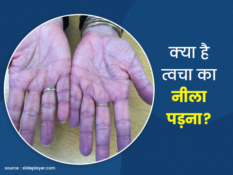 क्या है त्वचा के नीला पड़ने (सायनॉसिस) का कारण? जानें इसके खतरे और बचाव के लिए जरूरी टिप्स