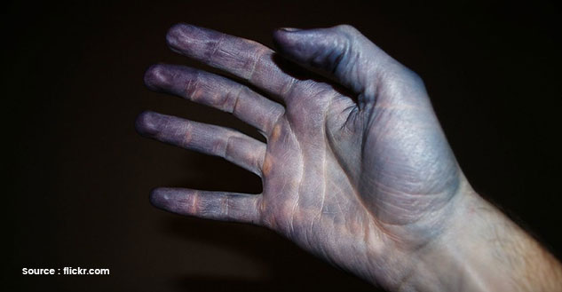 Cyanosis or Bluish Skin