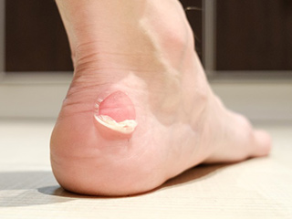 9 Home Remedies To Treat Foot Blisters At Home