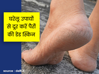पैरों की डेड स्किन सेल्स (मोटी और बेजान सफेद या काली चमड़ी) से छुटकारा पाने के 9 घरेलू उपाय