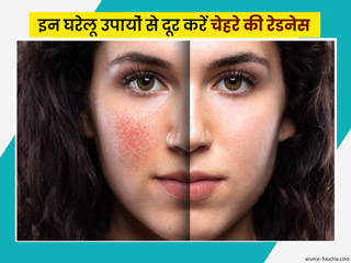क्या आपका चेहरा रहता है बहुत ज्यादा लाल? जानें चेहरे के लालपन (क्रॉनिक रेडनेस) को दूर करने के 9 घरेलू उपाय