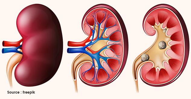 Kidney-Swelling-Nephritis-Causes-Symptoms-and-Treatment