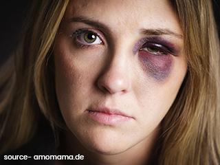 आंखों के आसपास कालापन और सूजन दूर करने के 9 घरेलू उपाय