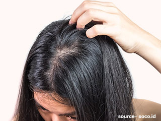 स्कैल्प की गंदगी साफ करने के लिए अपनाएं ये 9 घरेलू उपाय, रूक जाएगा बालों का झड़ना-टूटना