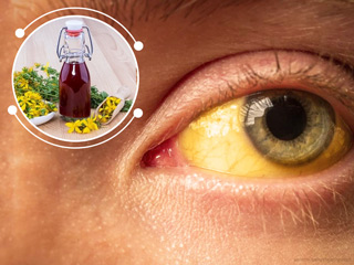 बिना पीलिया भी हो सकता है आंखों में पीलापन, इसे दूर करने के लिए अपनाएं ये आसान घरेलू उपाय