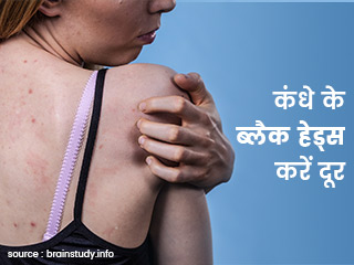 पीठ, कमर और कंधे के ब्लैक हेड्स काे निकालने के लिए आजमाएं ये 9 घरेलू उपाय