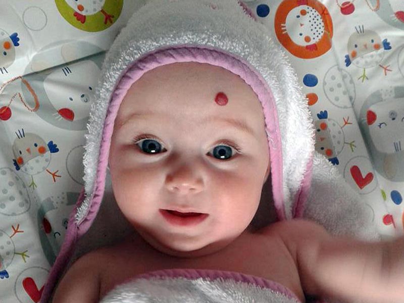 ज्यादातर बच्चों की त्वचा पर क्यों दिखते हैं जन्मजात निशान (बर्थमार्क)? डॉक्टर से जानें इसके बारे में सबकुछ