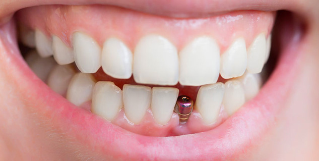 dental-cap-dental-crown