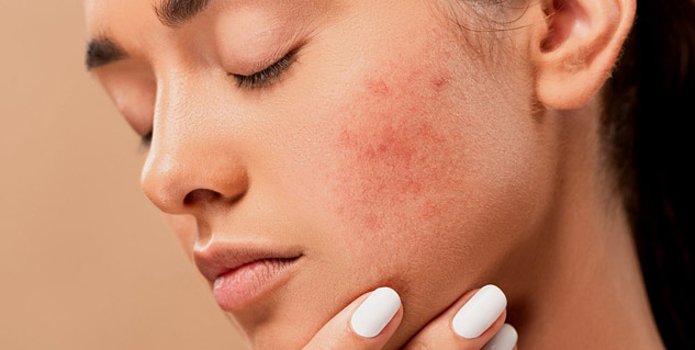 remedy to remove pimple marks on face