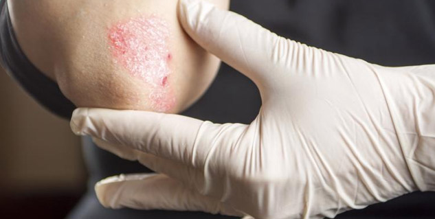 psoriasis Symptoms
