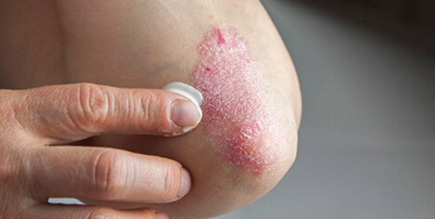 psoriasis Prevention Tips