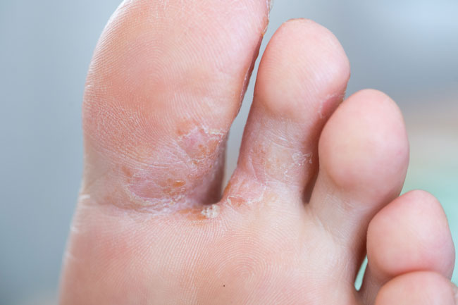 एथलीट्स फुट (Athlete's Foot)