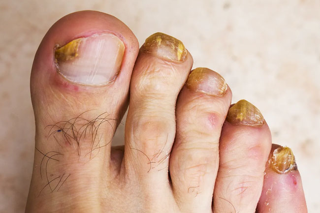 नेल इंफेक्शन (Nail Infection)