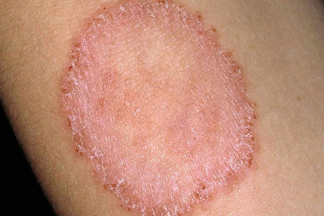 रिंगवर्म या दाद (Ringworm)