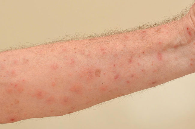 स्कैबीज़ या खाज (Scabies)