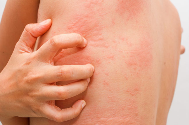 स्किन एलर्जी (Skin allergy)