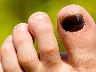 नाखून में खून जमने के लिए घरेलू नुस्खे