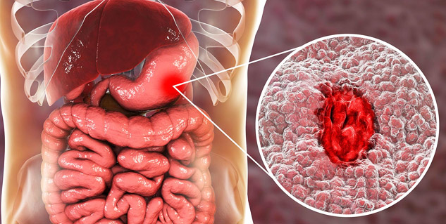 peptic Ulcer