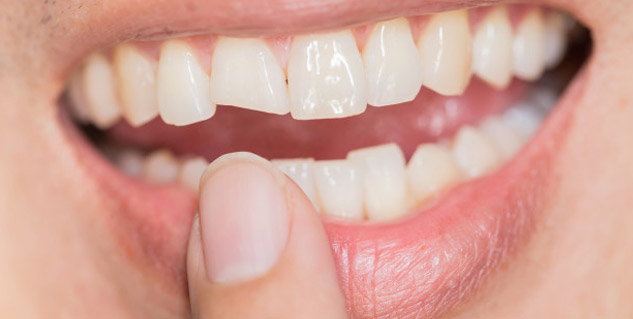 chipped teeth