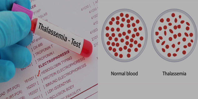 thallassemia