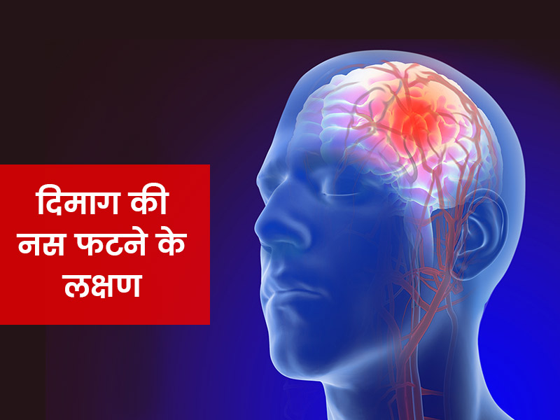 मस्तिष्क एन्यूरिज्म (धमनी विस्फार) के क्या होते हैं लक्षण, जानें कब होता है खतरनाक