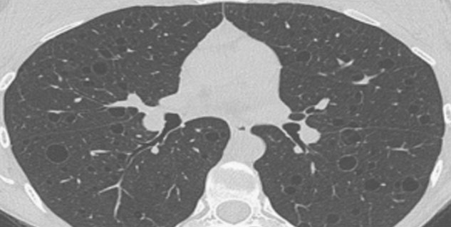 Inside1_HRCTTestforcovid