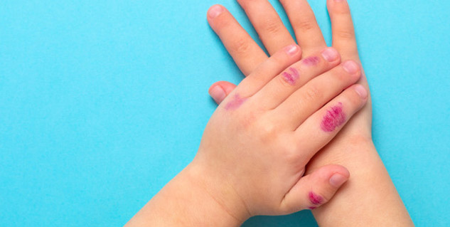 eczema in kids