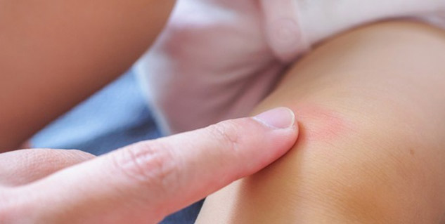 fungal infection in kids