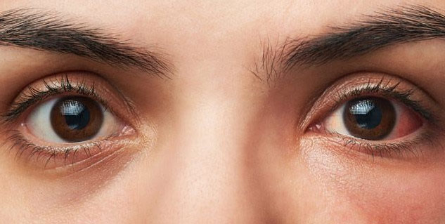 Inside1_conjunctivitisandcovid