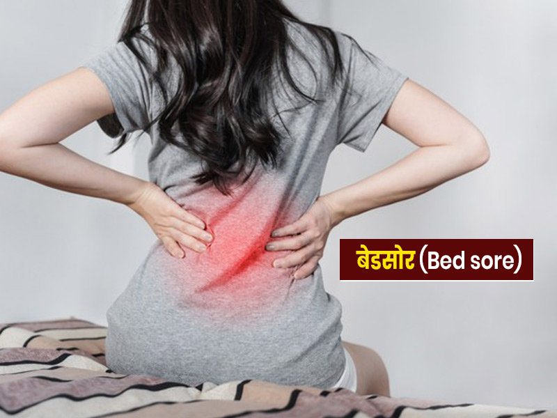 बेडसोर (Bed sore) के लक्षण और बचाव के टिप्स, लेटने-बैठने में त्वचा पर ज्यादा दबाव के कारण होती है ये समस्या