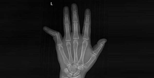 x-ray_of_disslocated_finger