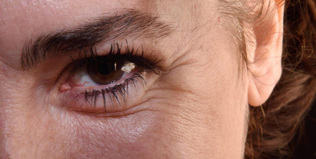 wrinkles under eye